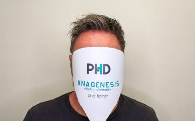 Νεόφυτος με σύστημα μαλλιών ELITE Oscar 003