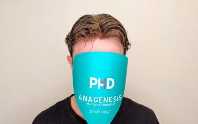 Γρηγόρης με σύστημα μαλλιών ELITE Oscar 003