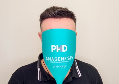 A Man With A Blue Object Over His Face Wearing Hair System